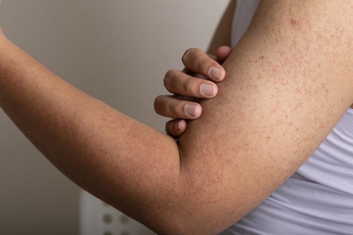 Arm with keratosis pilaris