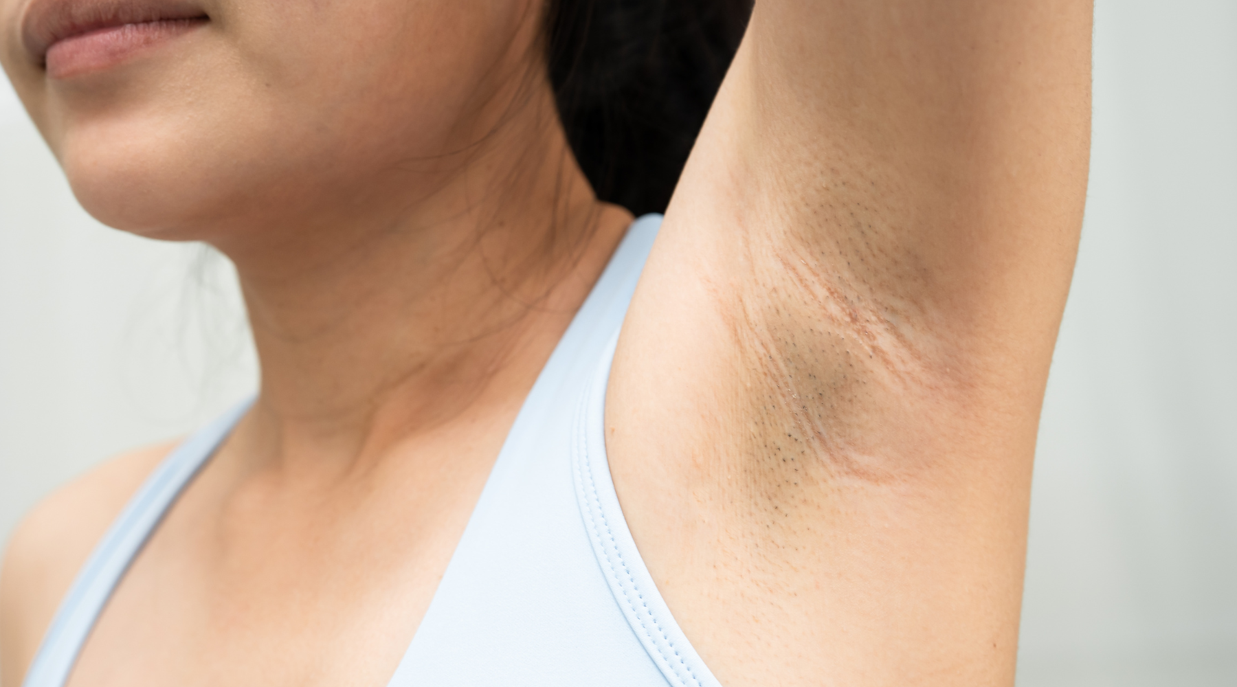 Dark underarms