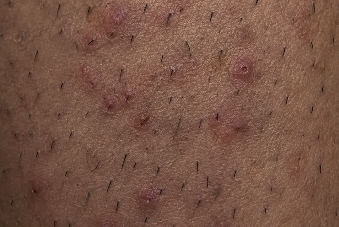 Close-up of skin with ingrown hairs and small bumps after shaving