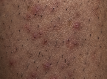 Close-up of skin with ingrown hairs and small bumps after shaving