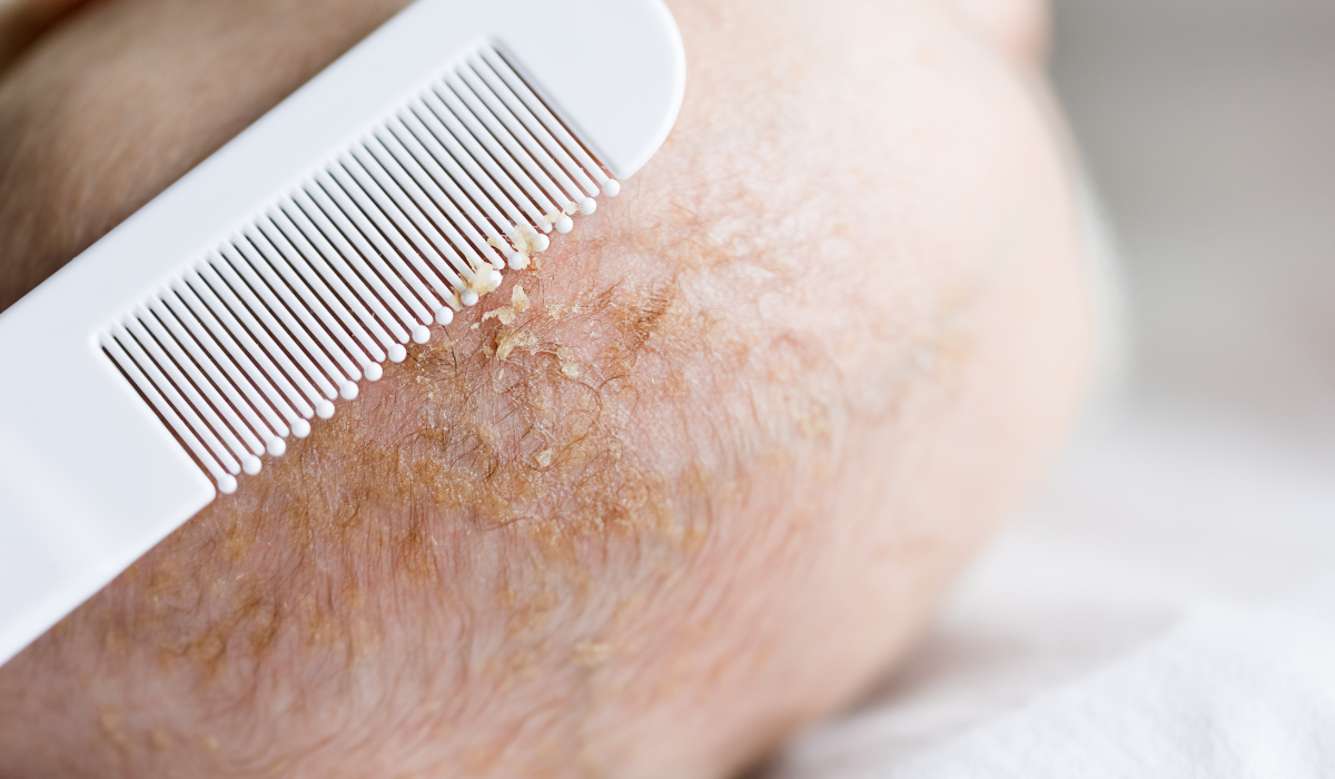 Cradle cap