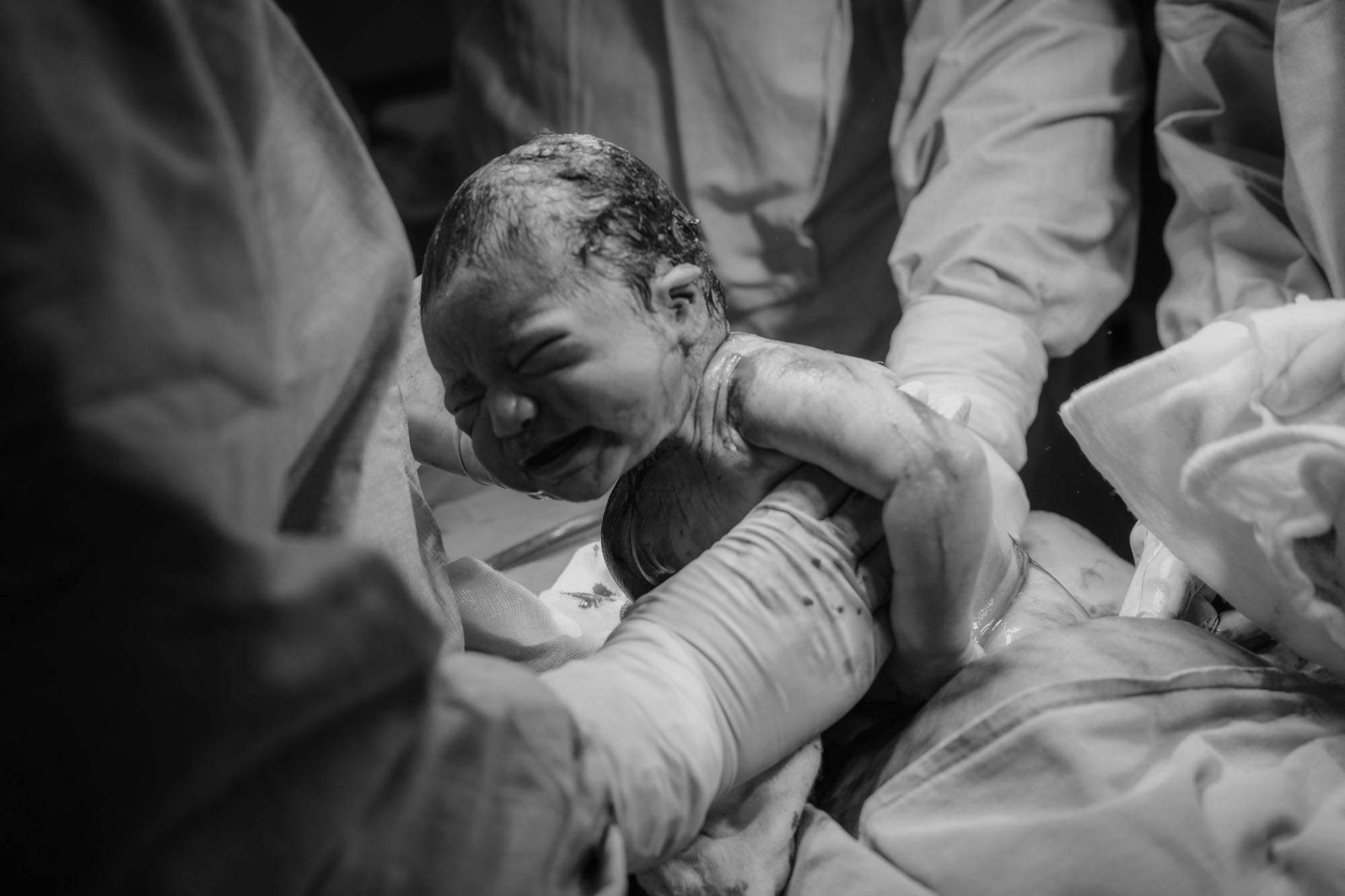 cesarean birth