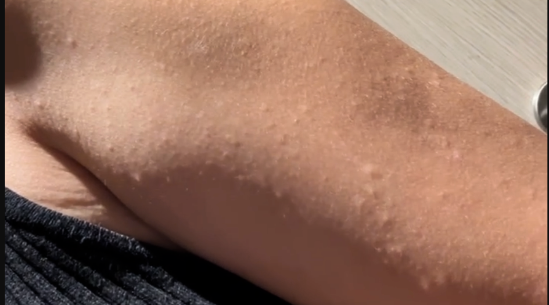 Hand with hives