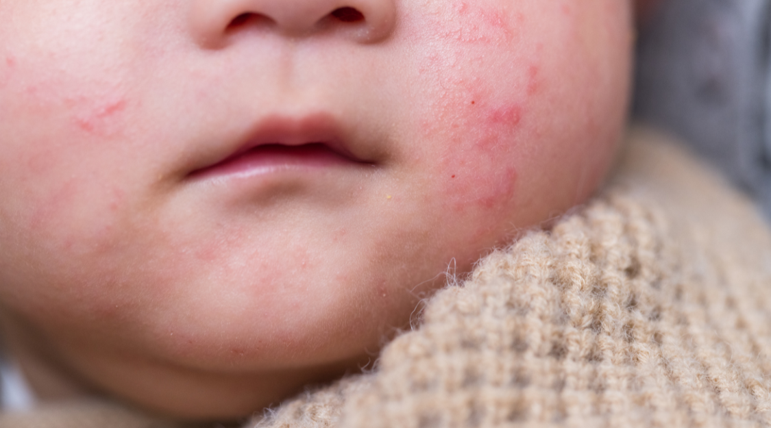 baby eczema