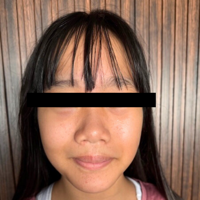 Oily & bumpy skin