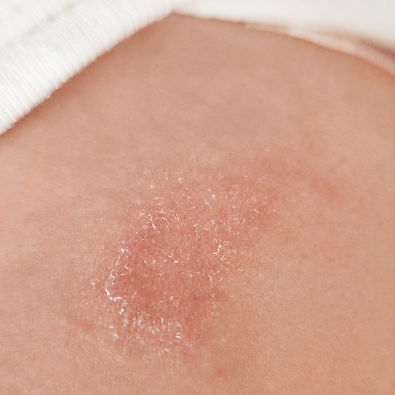 dry patches