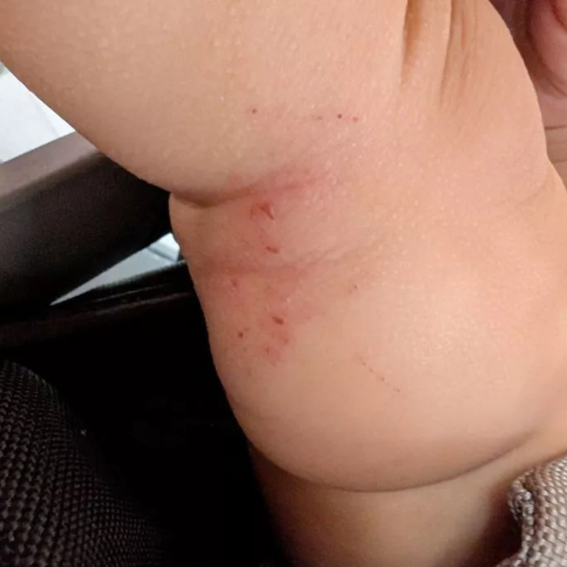 Eczema-prone skin
