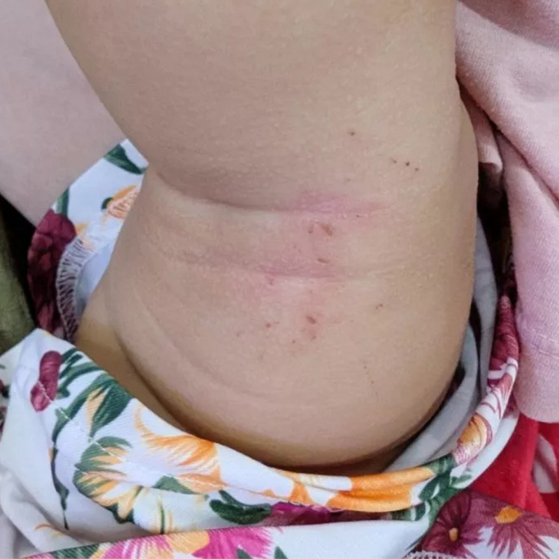 Eczema-prone skin