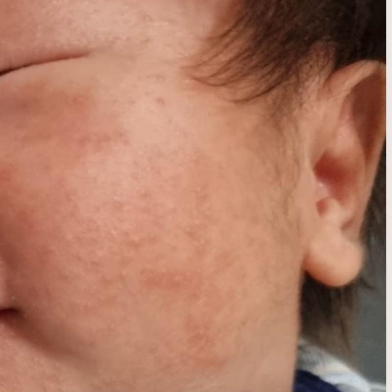 Baby acne