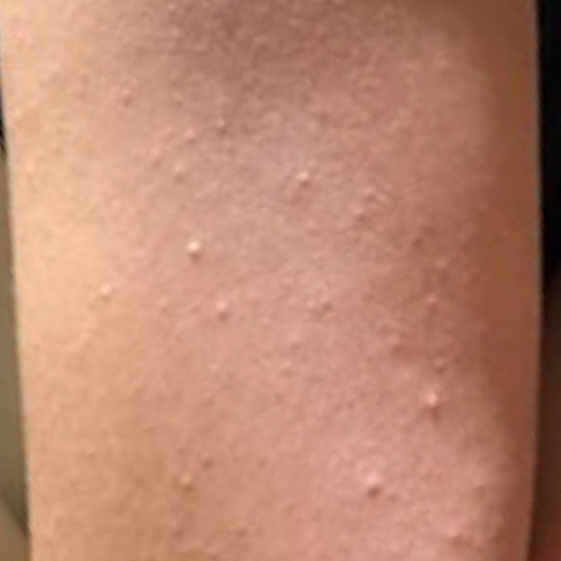 Keratosis Pilaris