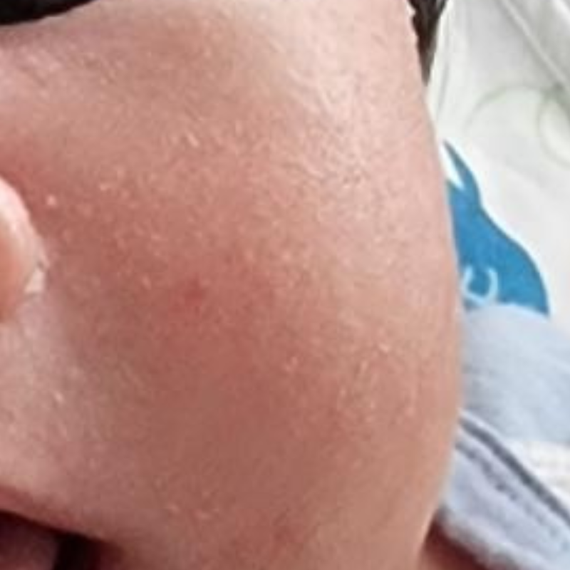 Baby acne