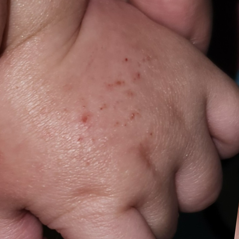 Redness & Scabbing
