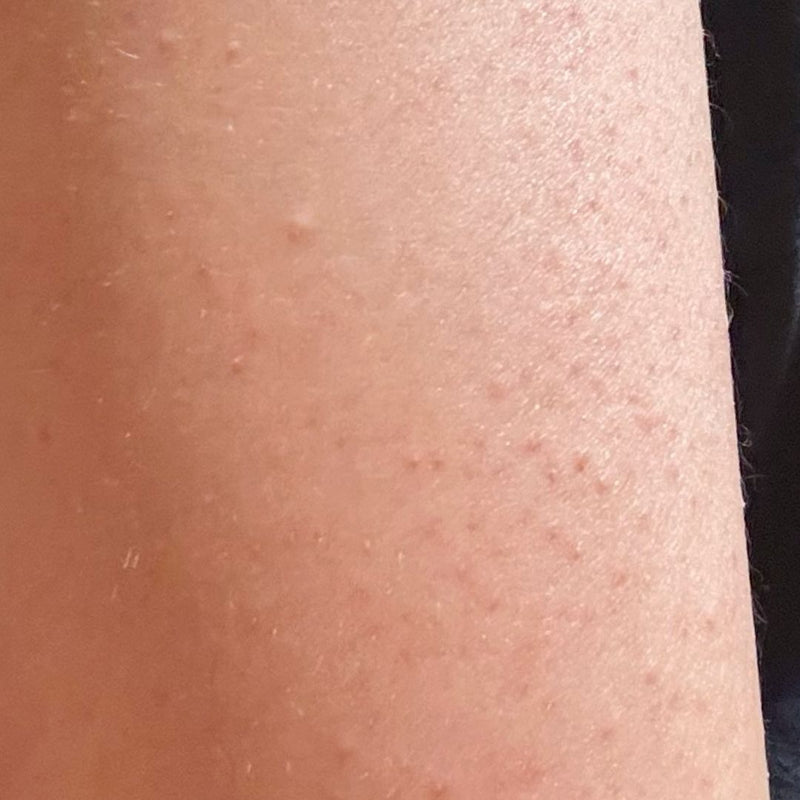 Keratosis Pilaris