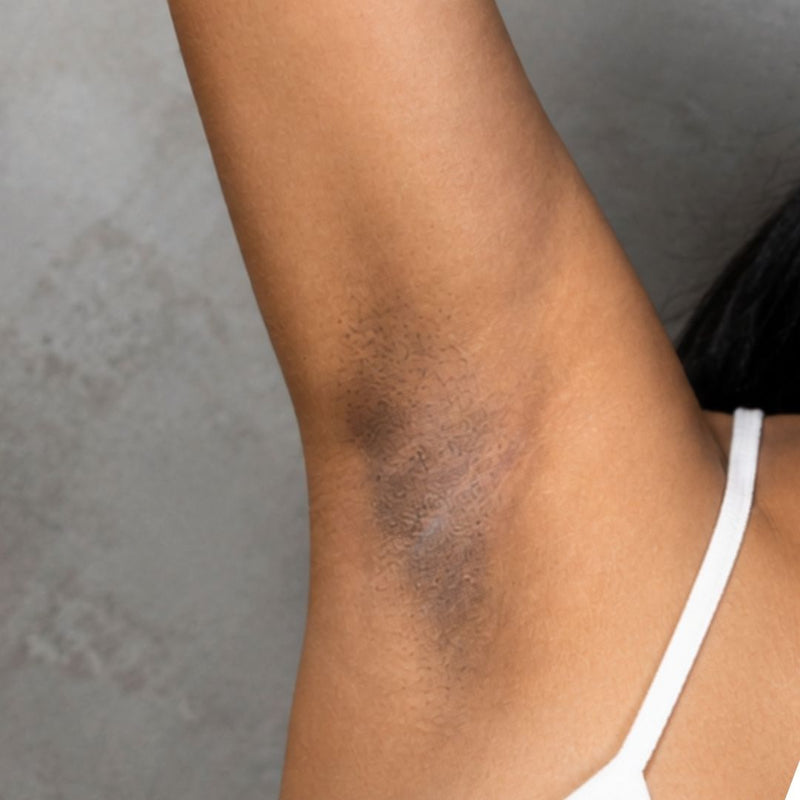 Dark Underarms