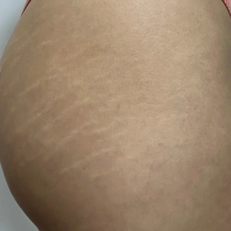 Stretch Marks