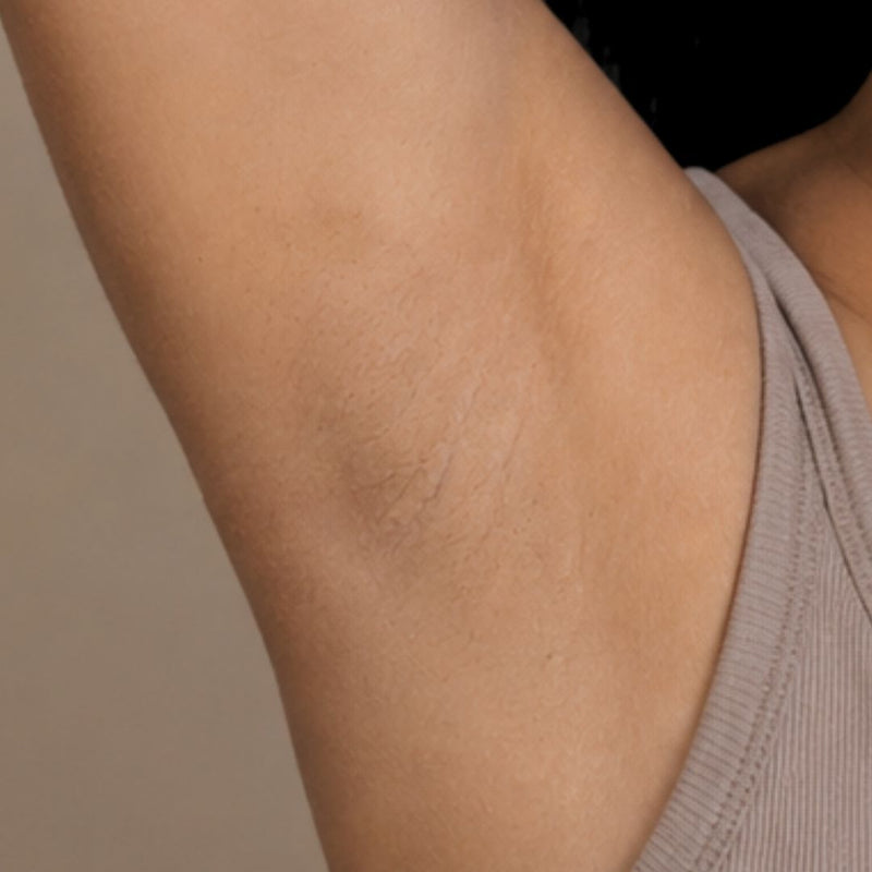 Dark Underarms