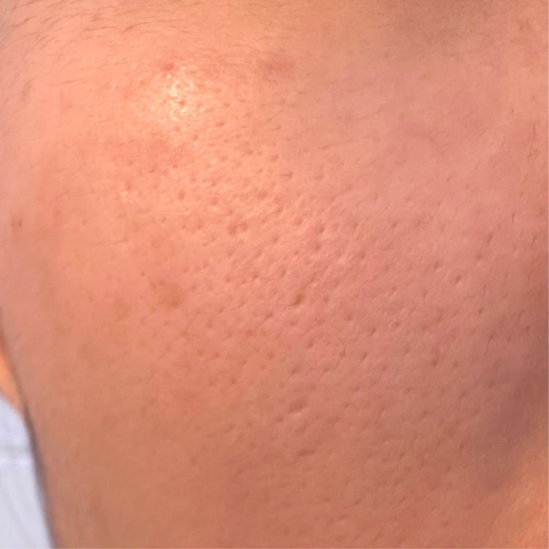 Dark Spots & Pores