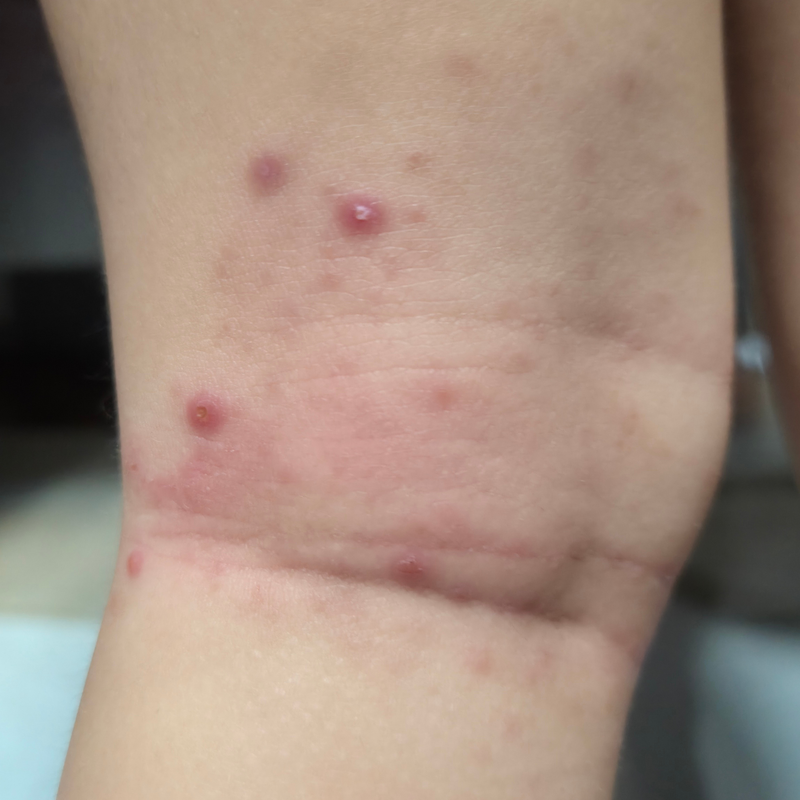 Eczema-prone skin