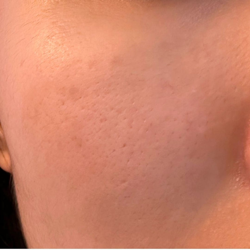 Dark Spots & Pores