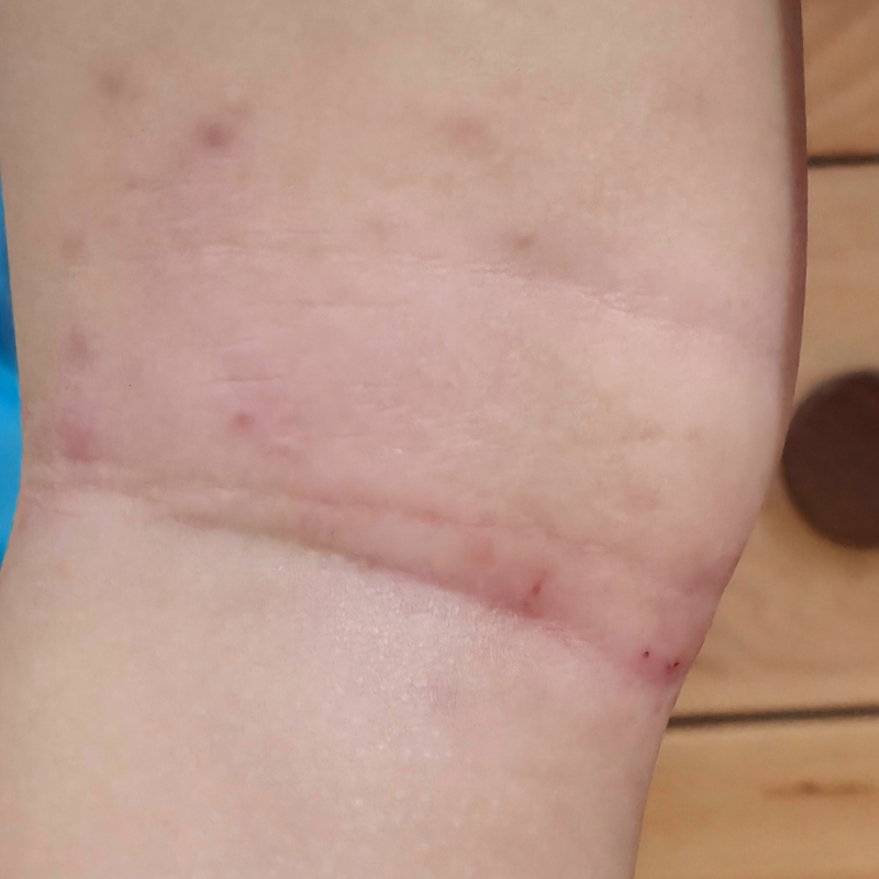 Eczema-prone skin