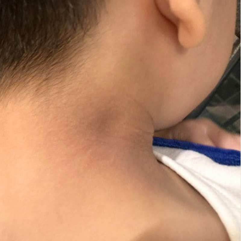 Post-inflammation darkness