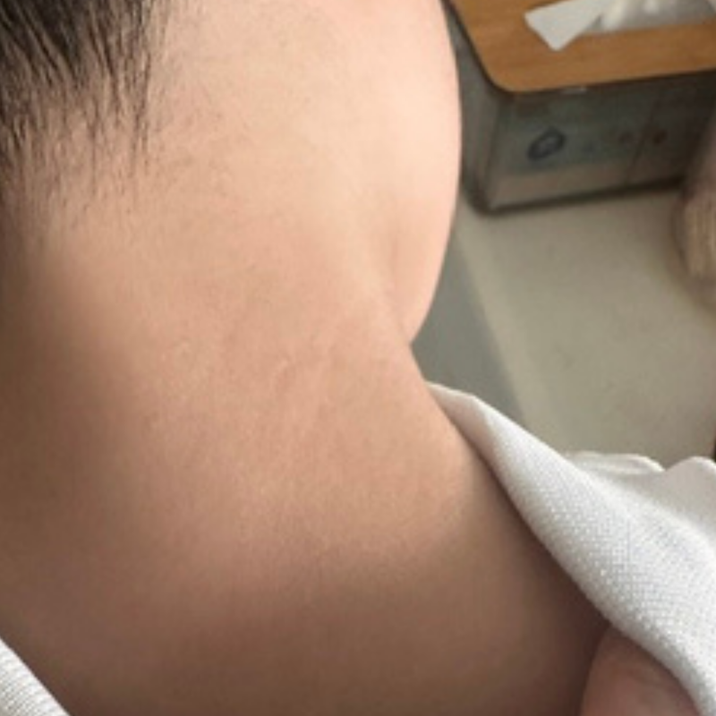 Post-inflammation darkness