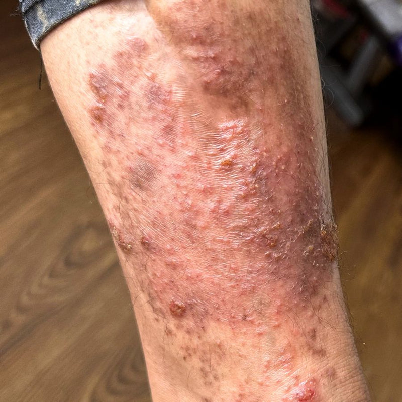 Eczema