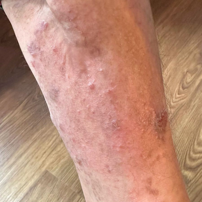 Eczema