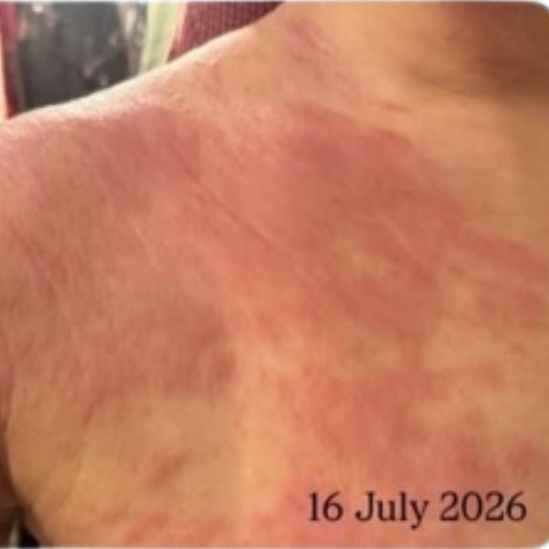 Hives