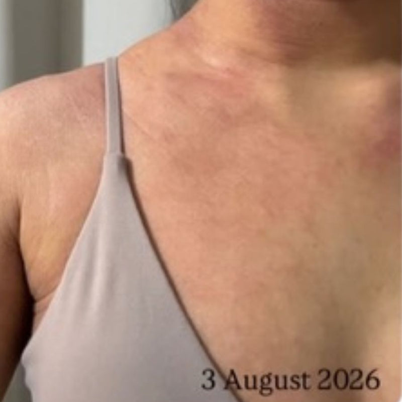 Hives