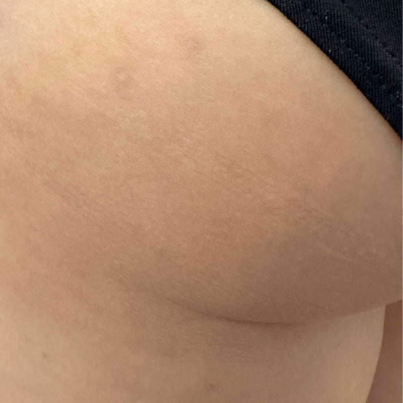 Post inflammation pigmentation