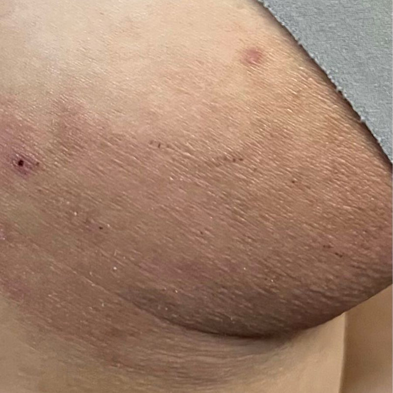 Post inflammation pigmentation