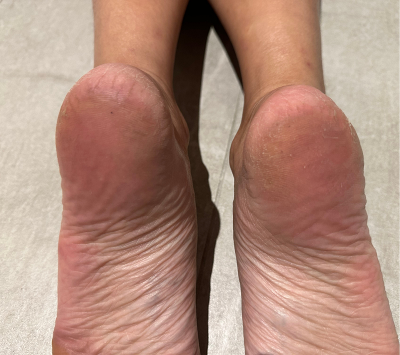 Cracked Heels