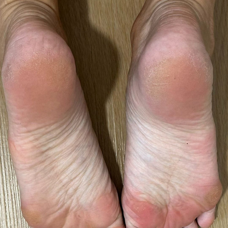 Cracked Heels