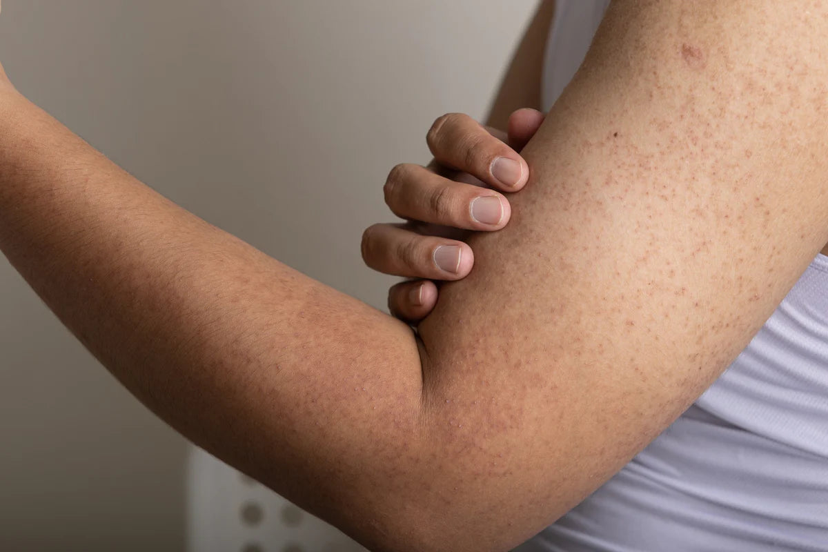 Managing Keratosis Pilaris or Strawberry Skin