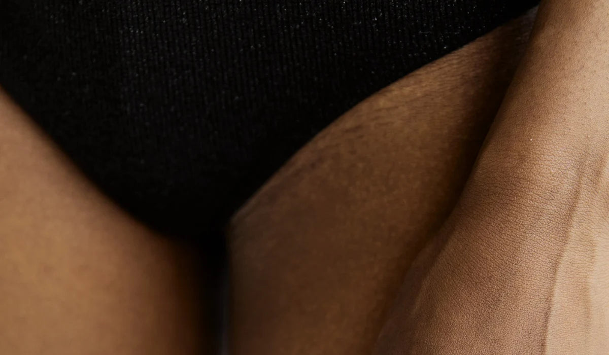 Thigh Chafing: How to Soothe It and Fade the Dark Marks