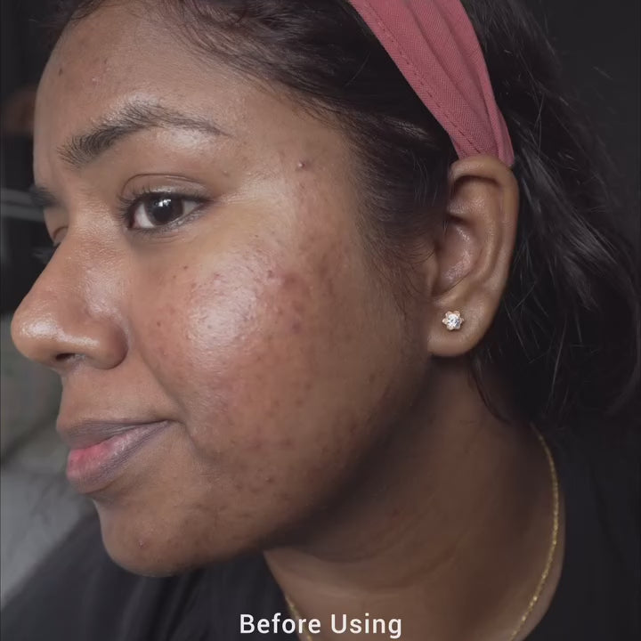 a girl using saya brightening peel on her face
