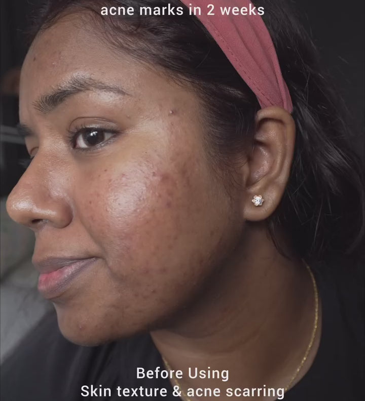 a girl using saya brightening peel on her face