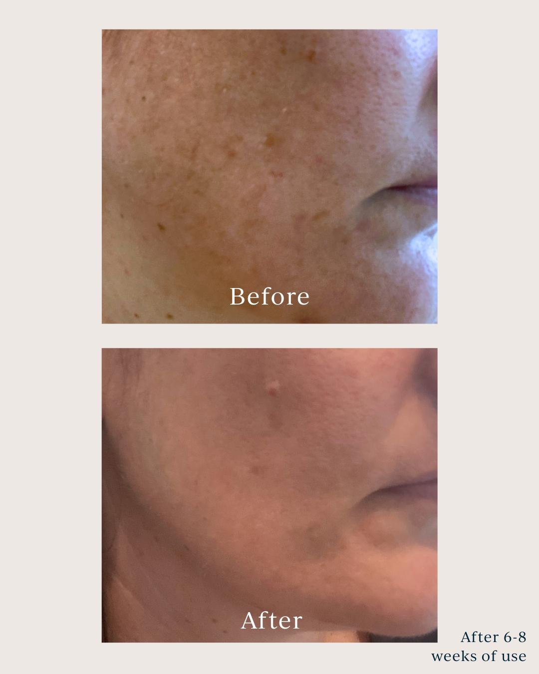 dark spots before and after using saya brightening peel