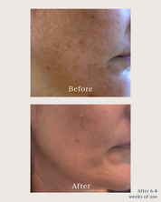 dark spots before and after using saya brightening peel