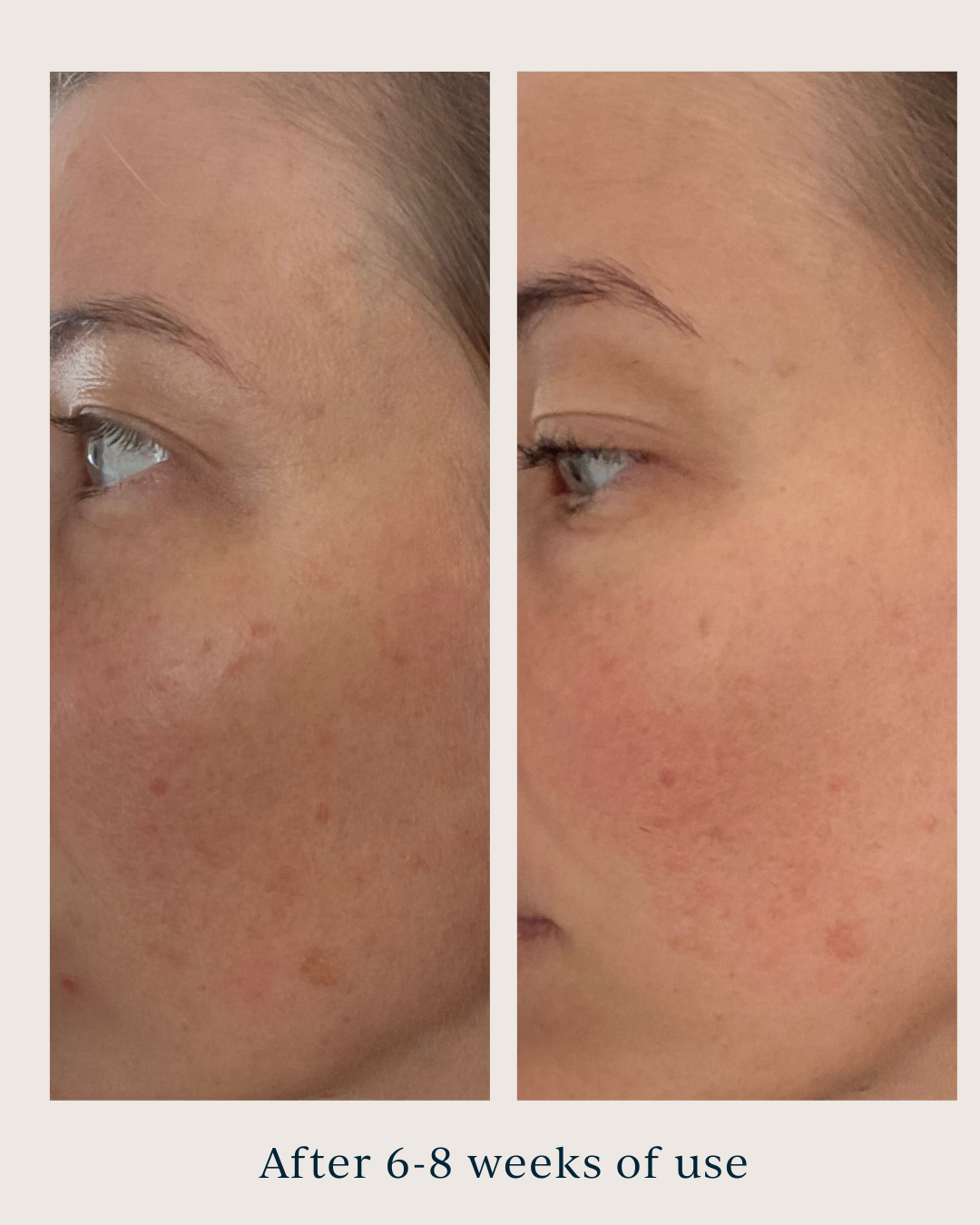 dark spots before and after using saya brightening peel