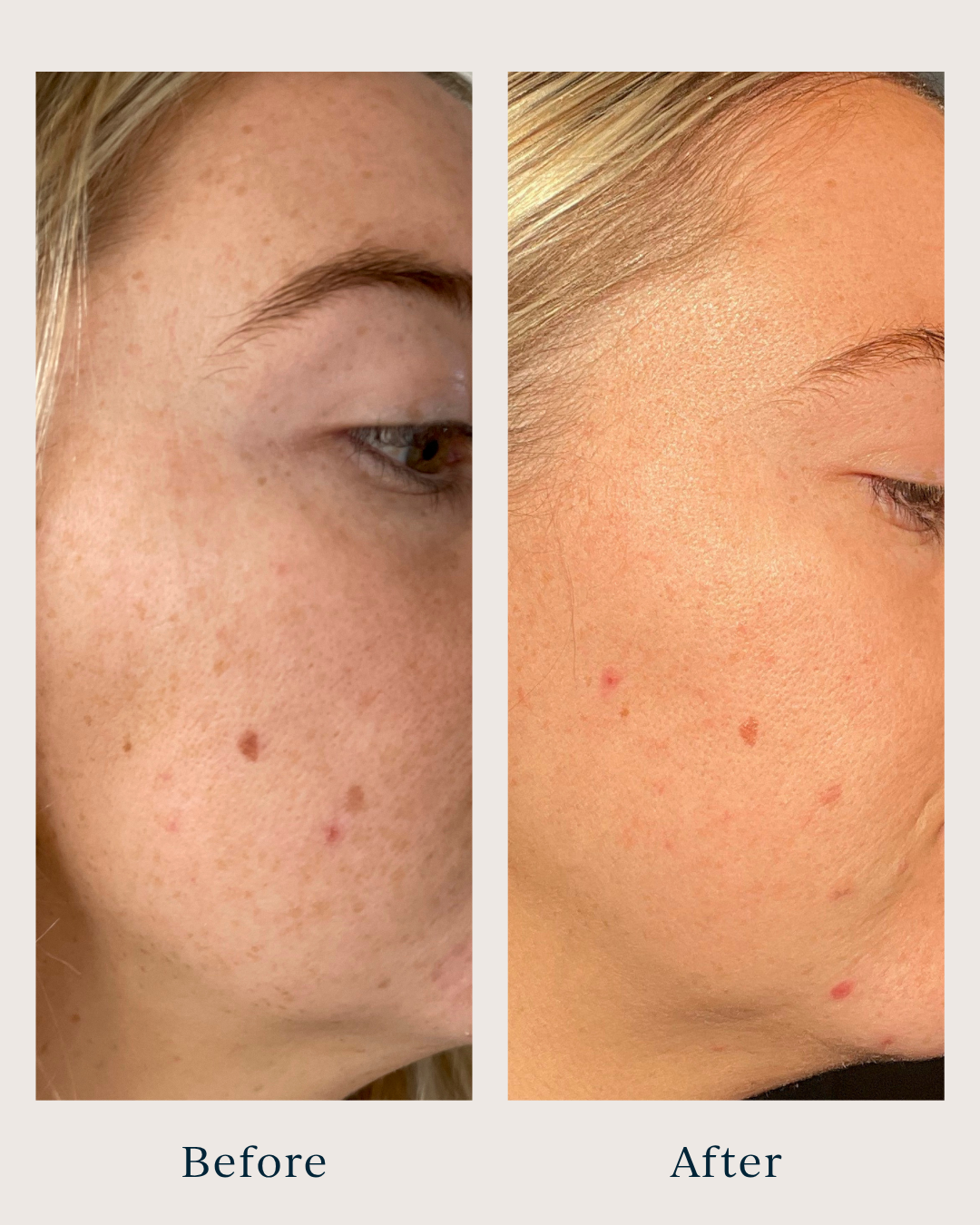 before and after pictures of a woman after using brightening peel