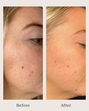 before and after pictures of a woman after using brightening peel