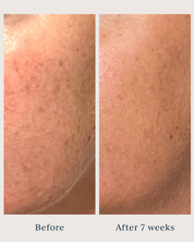 before and after pictures of a woman after using brightening peel