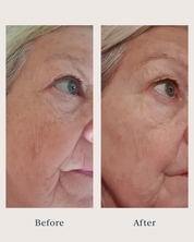 before and after pictures of a woman after using saya renew serum