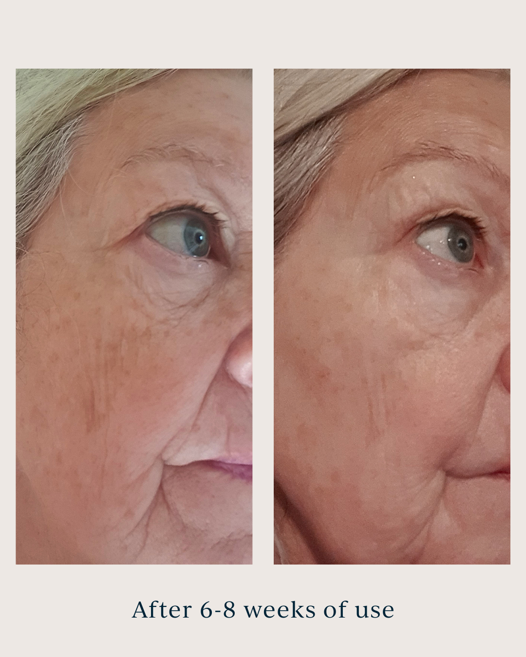 dark spots before and after using saya renew serum