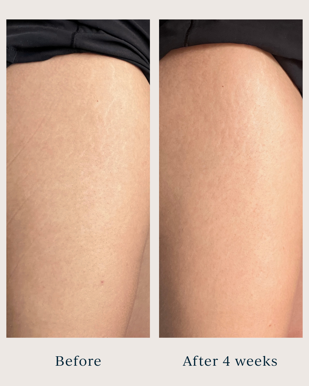 stretch marks before and after using saya argan body oil