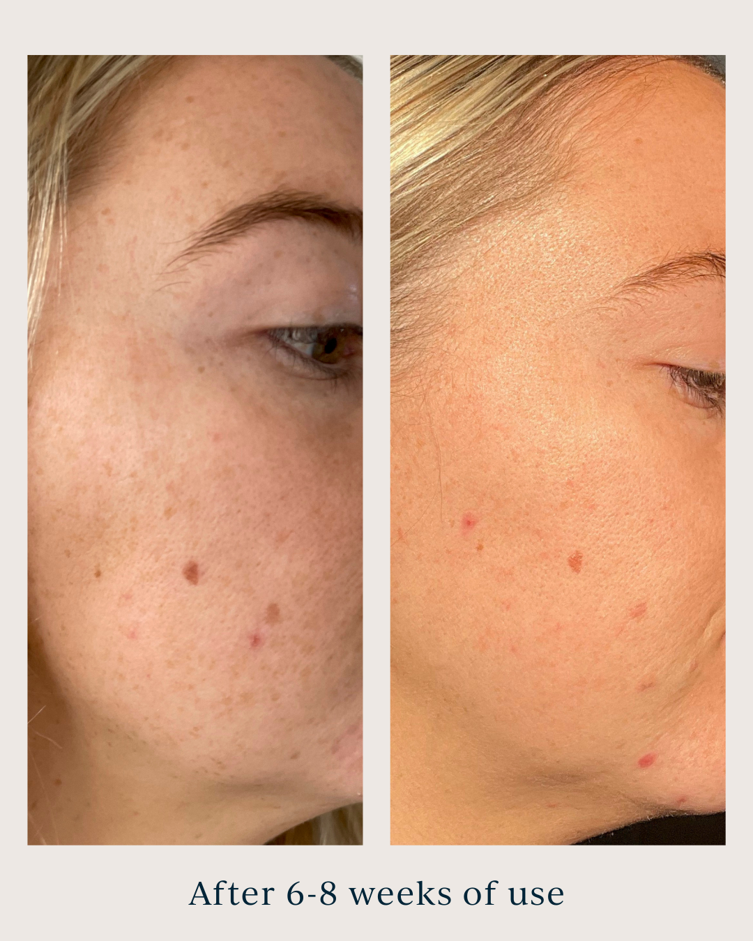 skin tone and texture before and after using saya brightening peel