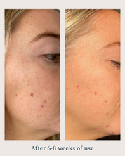 skin tone and texture before and after using saya brightening peel