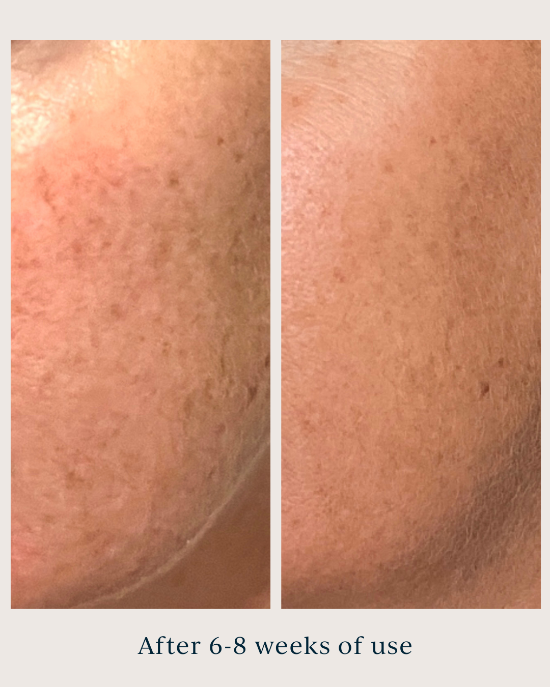 dark spots before and after using saya brightening peel